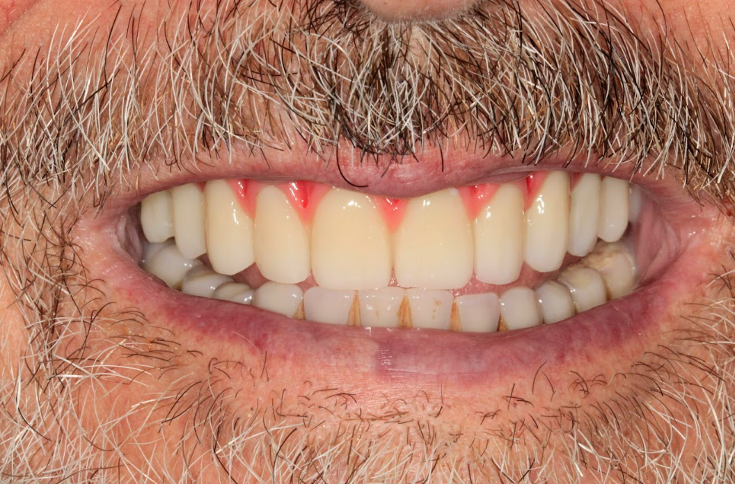 The patient's final smile, showing fully restored aesthetics and function with the XGATE screw-retained prosthesis.