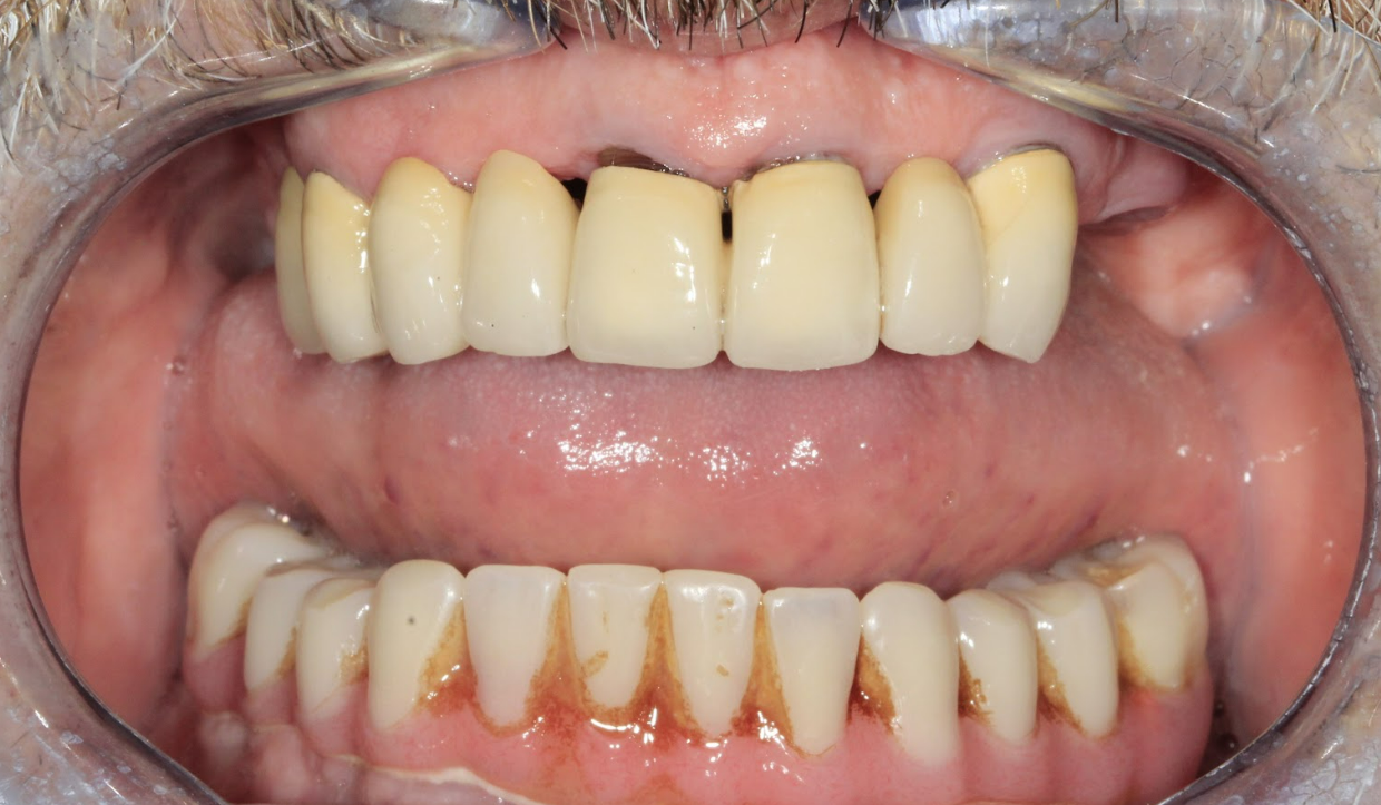 Initial clinical situation of a 73-year-old patient showing a damaged upper overdenture.
