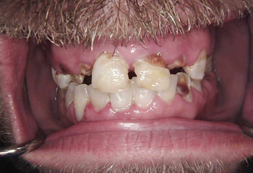 Frontal view of the patient's initial smile showing advanced tooth decay and non-restorable anterior teeth.