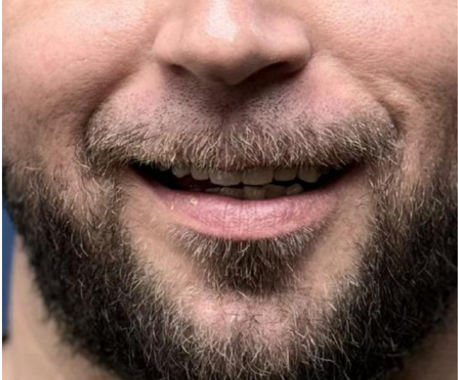 The patient's appearance and natural, harmonious smile achieved with the PMMA provisional restoration.