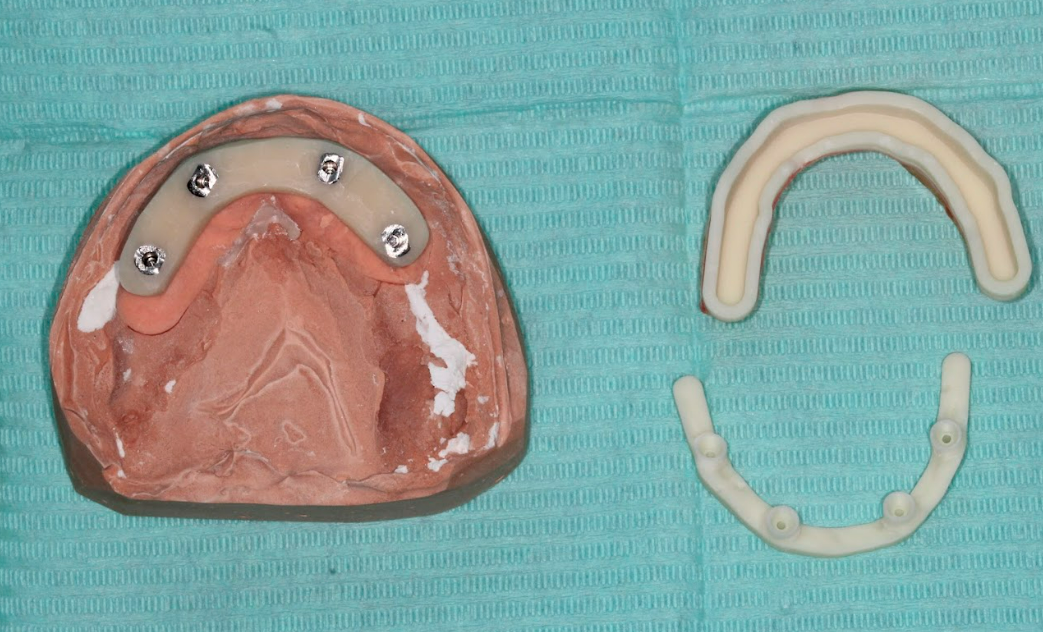 A resin verification jig on the master cast, used to confirm the accuracy of the final impression.