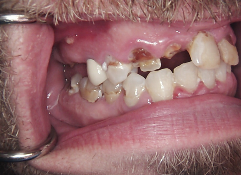 Severe dental caries and decay in the posterior segments of the maxilla and mandible due to xerostomia.