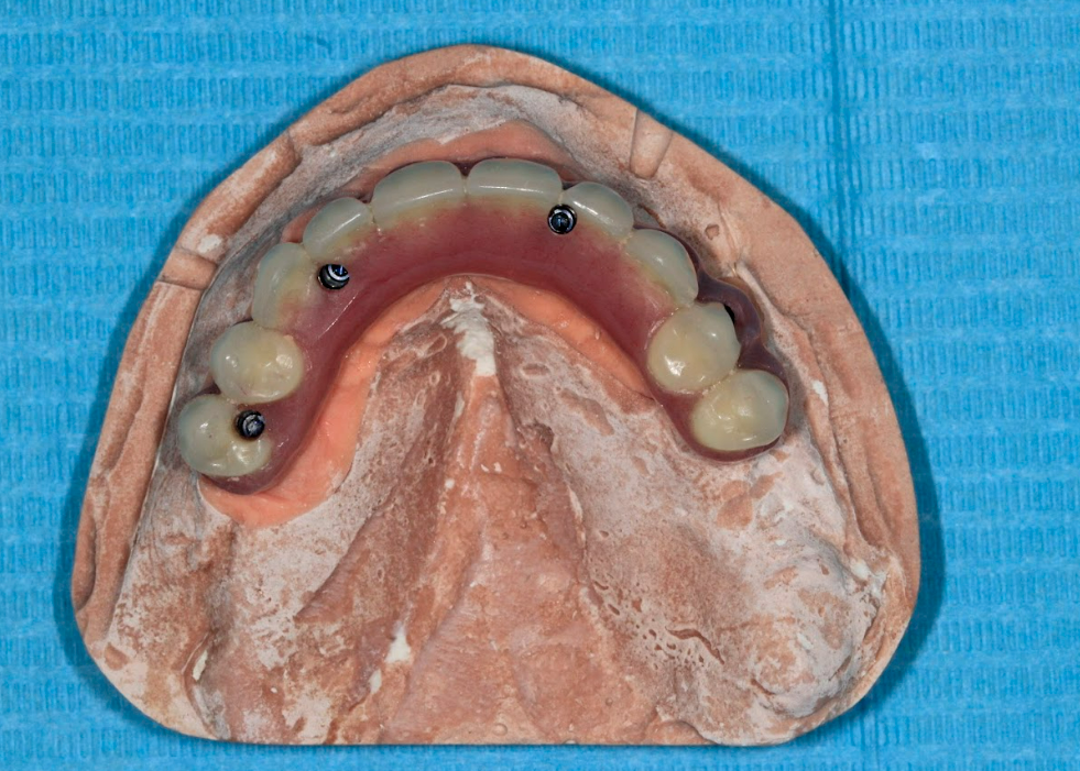 Temporary acrylic resin prosthesis on the laboratory cast, showing three screw access channels.