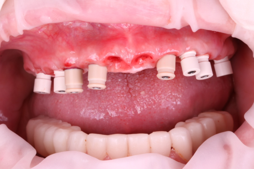 Frontal intraoral view of the temporary prosthesis on 8 maxillary implants, used for soft tissue contouring and occlusion stabilization.