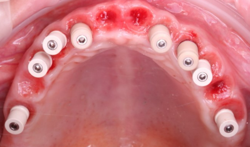 Occlusal intraoral view of the temporary prosthesis on 8 maxillary implants, showing the screw-access channels.