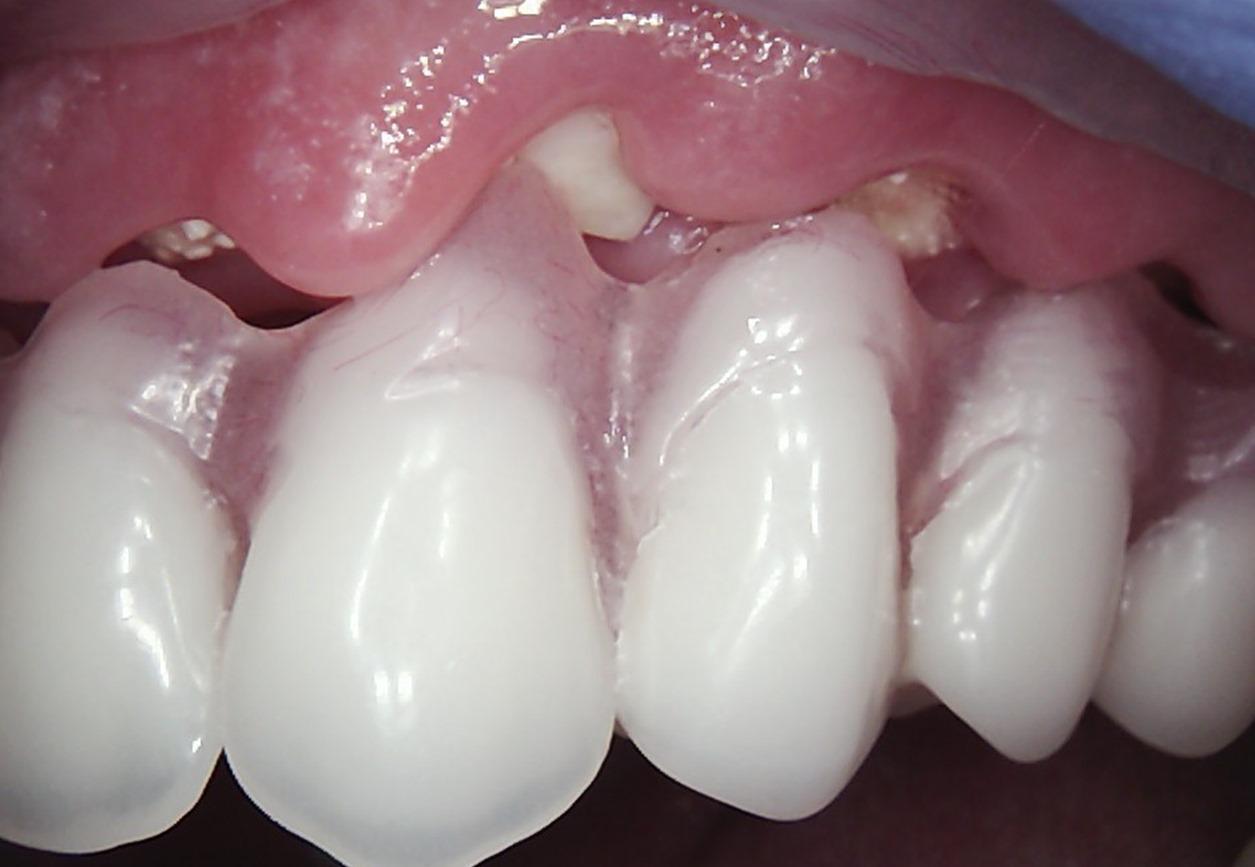 Temporary removable prosthesis supporting gingival contours and preserving interdental papillae post-surgery.