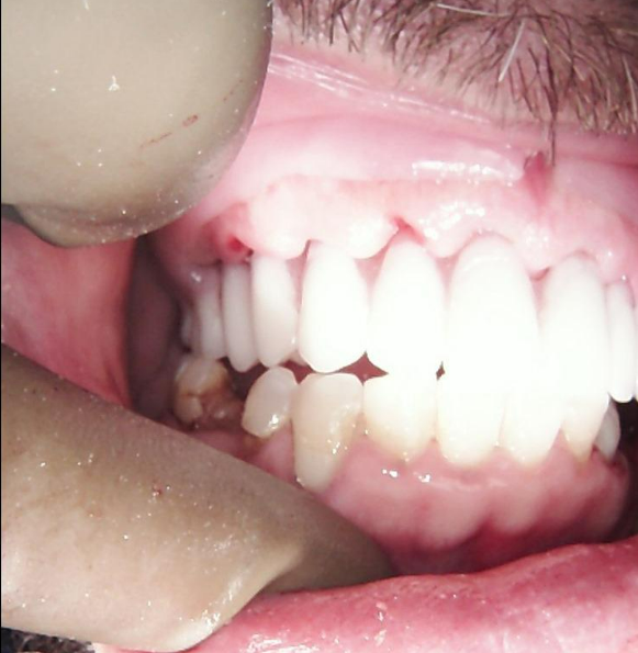 Clinical fit of the temporary removable prosthesis two weeks after multi-unit abutment implant placement.