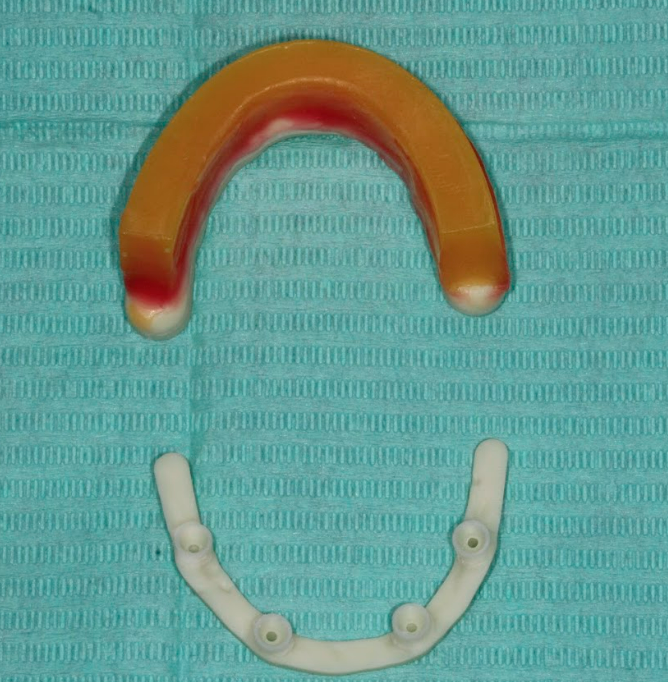Screw-retained verification jig with a wax rim to verify the vertical dimension of occlusion.