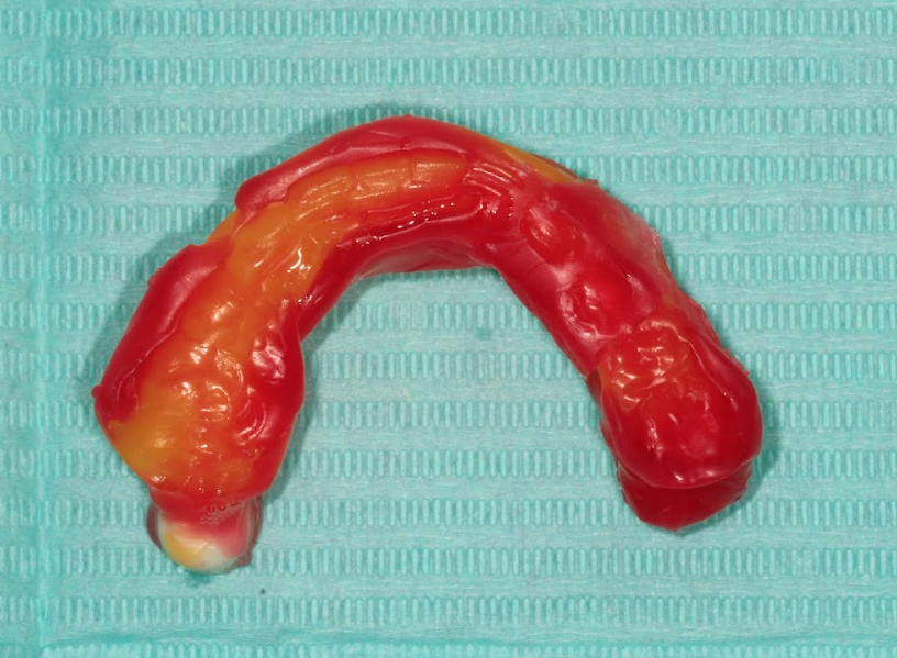 Occlusal bite registration captured in wax.