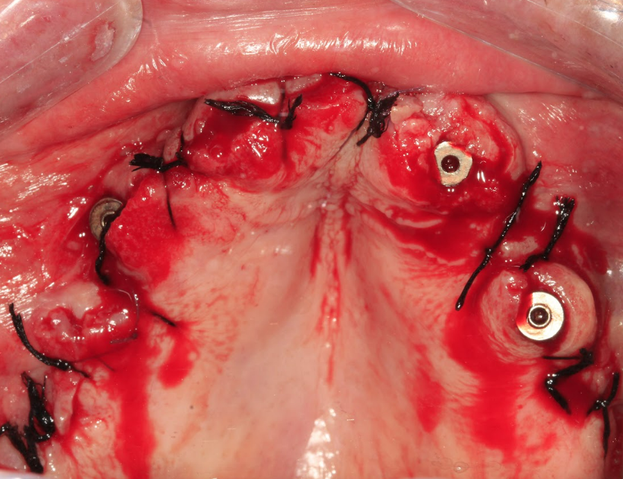 Occlusal view after placement of four XGATE implants and multi-unit abutments, with sutures in place.