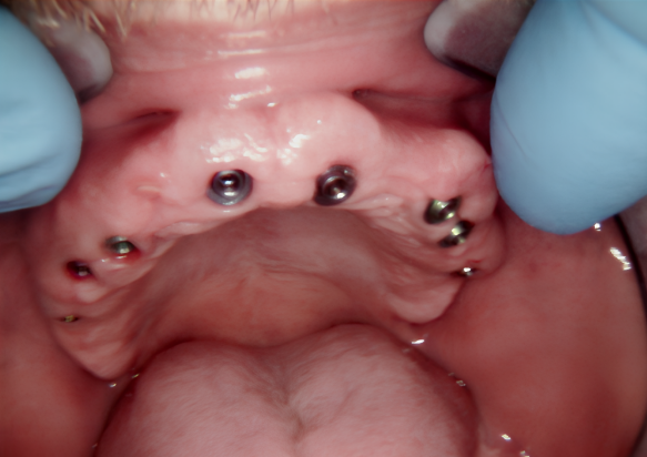 Occlusal view of the eight XGATE multi-unit abutments placed in the maxilla before impression for the provisional bridge.