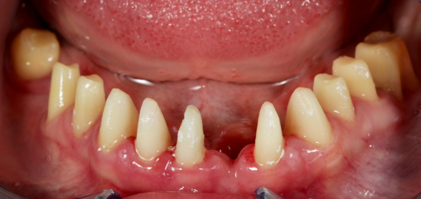 3D computed tomography scan showing maxillary implant treatment planning with six implant positions marked