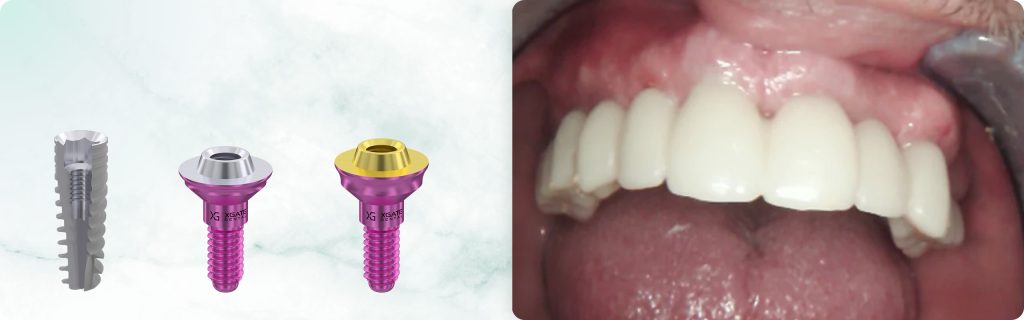 Full Maxillary and Partial Mandibular Rehabilitation Using XGATE Dental Multi-Unit Abutments and Implants