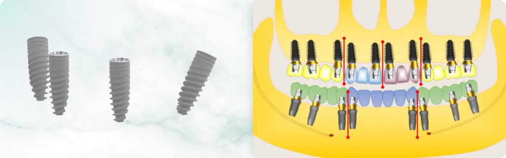 Thread, Taper, and Reverse Taper: How Implant Shape Determines Its Application. Part 2