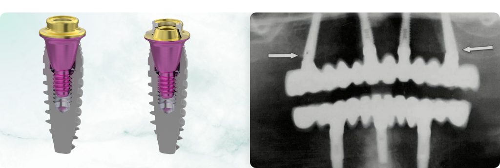 How to Avoid Errors and Complications During Dental Implantation