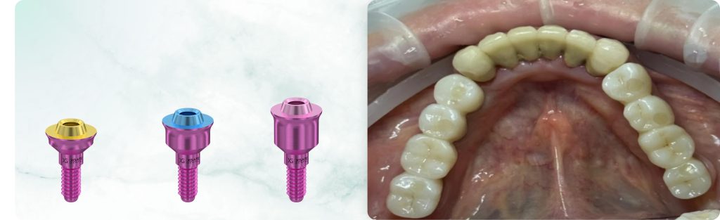 Replacement of a Removable Denture with a Permanent Implant-Supported Restoration: Screw Retention on MUA V-Type XGATE Dental