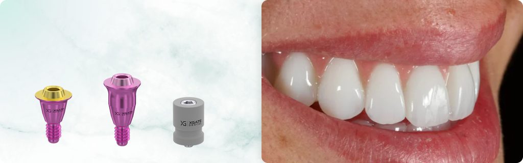 Full-Arch Restoration of the Maxilla Using a Digital Protocol and Ultra-Compact XGATE Dental V-Type Multi-Units