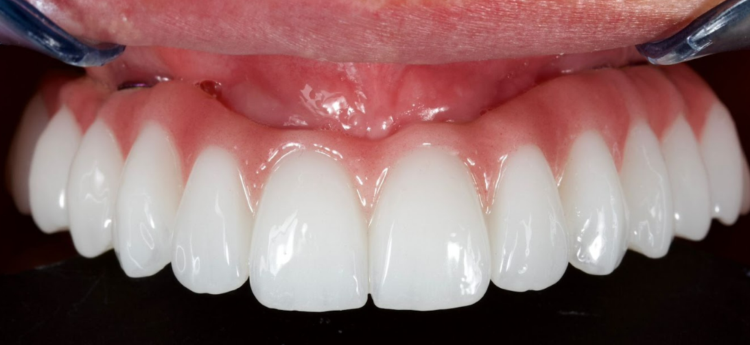 CAD/CAM design of full-arch zirconia bridge showing frontal view with anatomical tooth contours and emergence profile