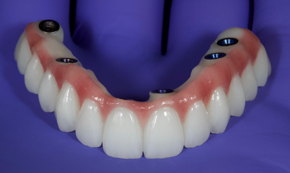 CAD/CAM design of full-contour zirconia bridge for maxillary full-arch restoration, occlusal view showing screw access holes