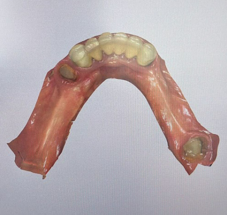 Intraoral view of the patient's mandibular arch with an old clasp-retained removable denture before implant treatment.
