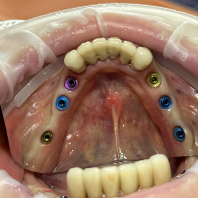 Intraoral occlusal view of the mandible showing six placed XGATE V-Type Multi-Unit Abutments with color-coded healing caps.