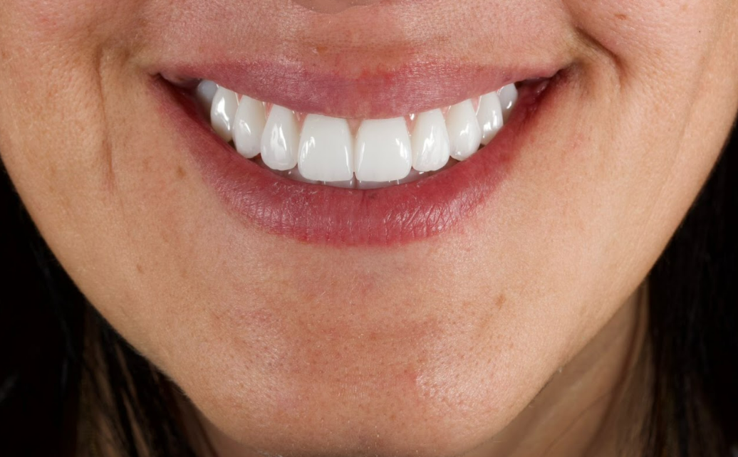 Frontal close-up view of completed full-arch maxillary restoration showing natural tooth morphology and gingival harmony