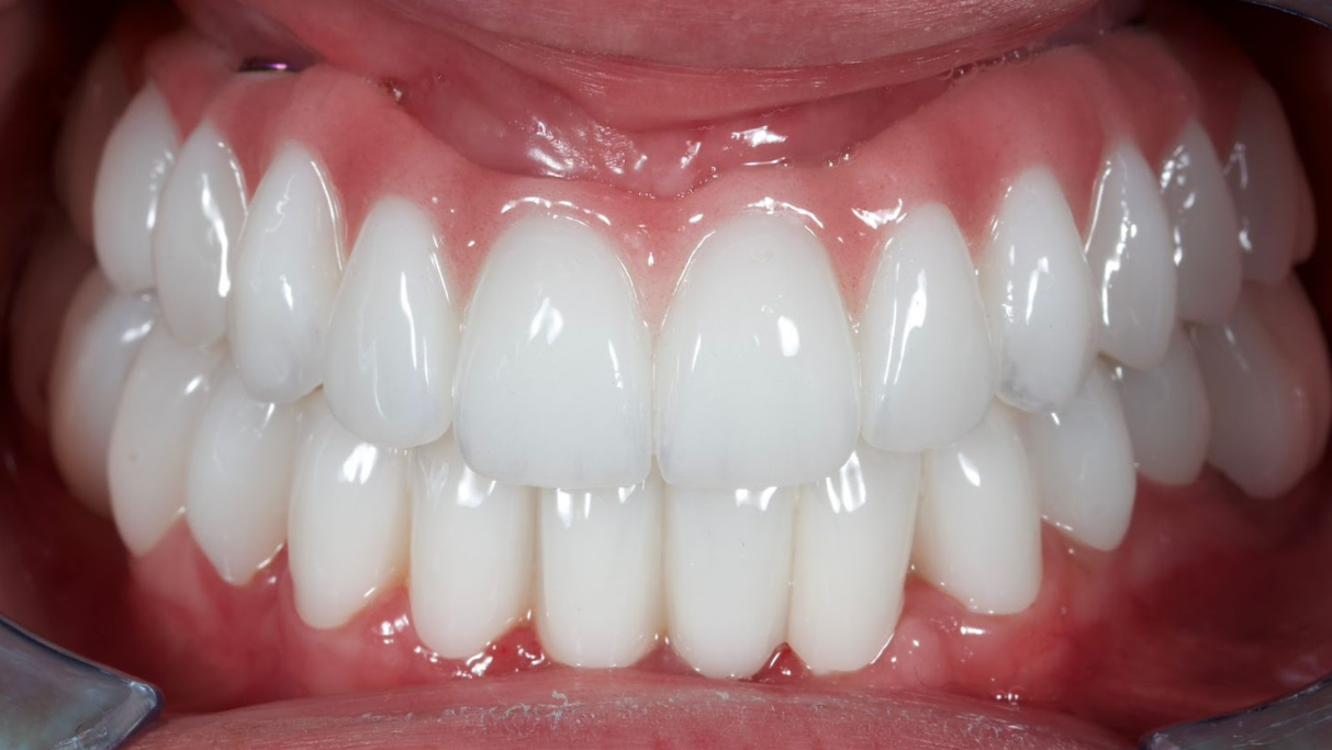 Final full-arch zirconia restoration on maxilla, occlusal view showing screw-retained prosthesis with sealed access holes
