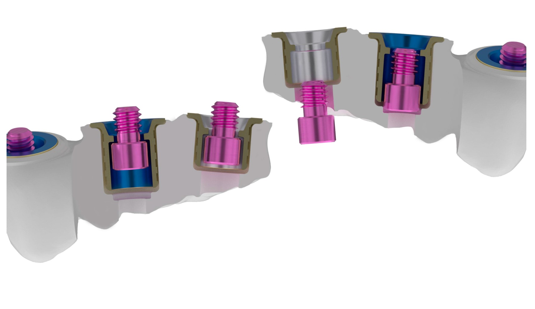 Diagram showing insufficient space between implant platform and antagonist tooth, demonstrating need for ultra-low profile MUA