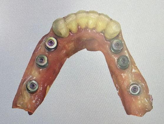 Basal Surface of Screw-Retained Zirconia Bridge
