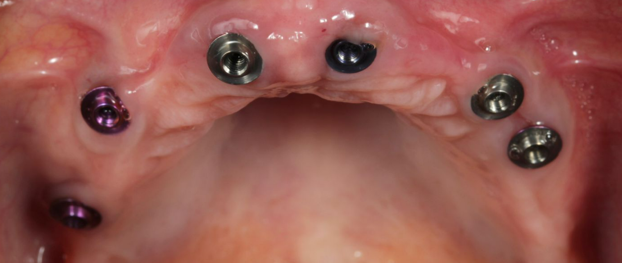 XGATE MUA V-Type multi-unit abutments with color-coded markings indicating different gingival heights installed on implants