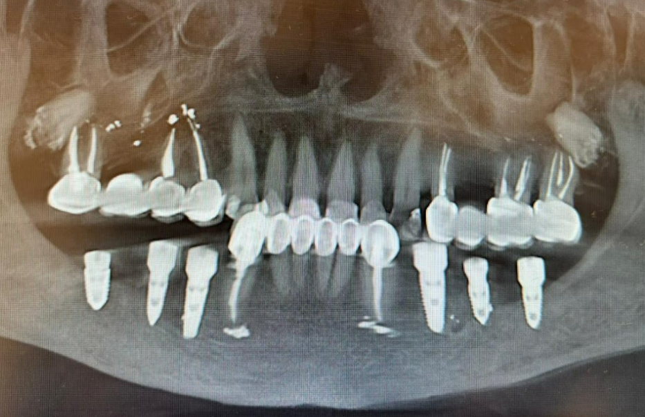Post-operative OPG X-ray confirming precise fit of the full arch restoration on XGATE implants.