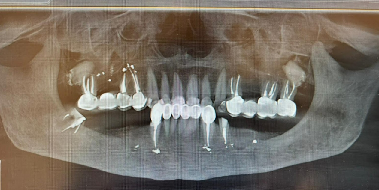 Pre-operative panoramic radiograph showing failing teeth 34 and 48 and the patient's old removable denture situation.