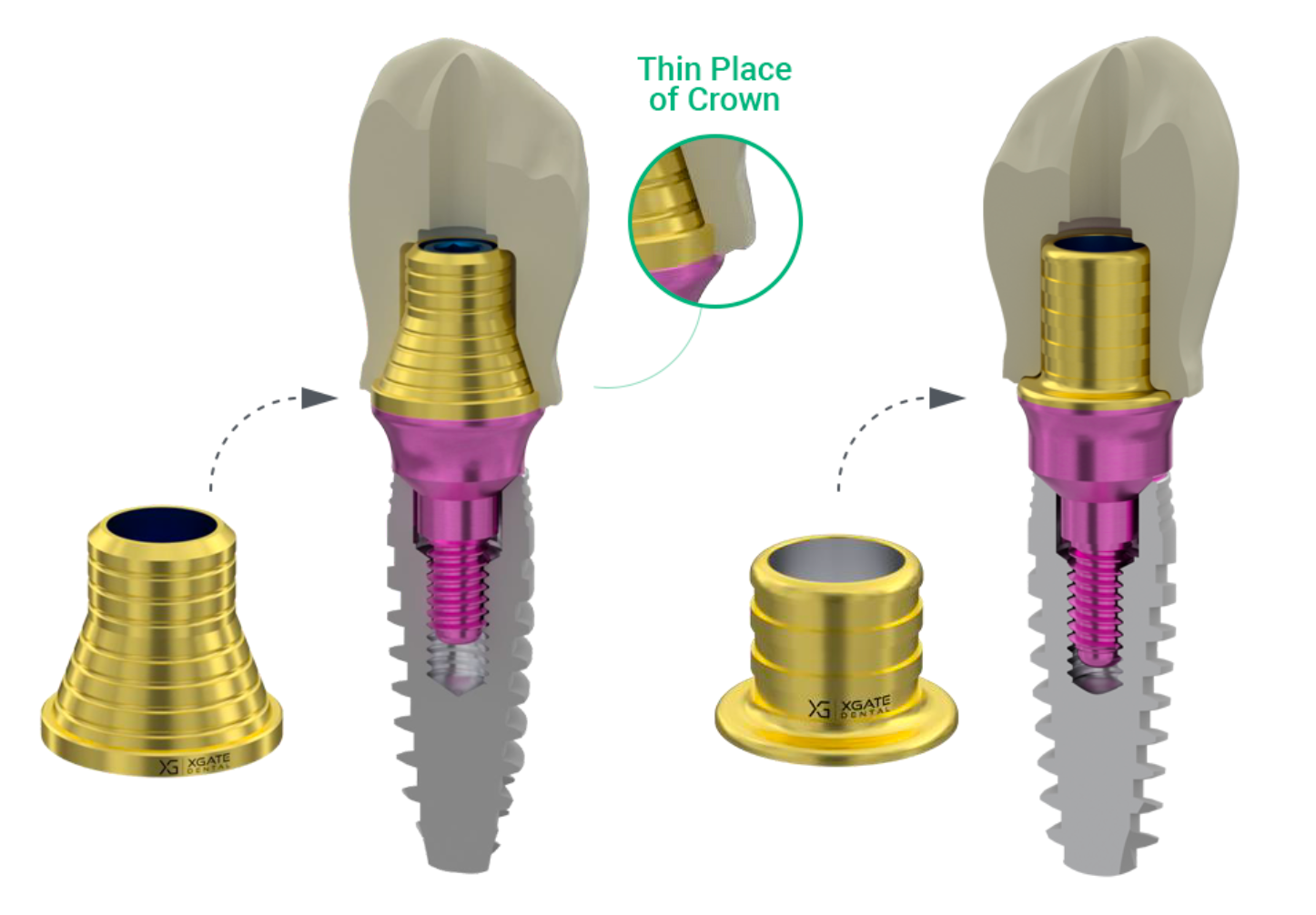 Comparison diagram showing XGATE V-Type MUA providing more restorative space and thicker zirconia material compared to standard abutments.