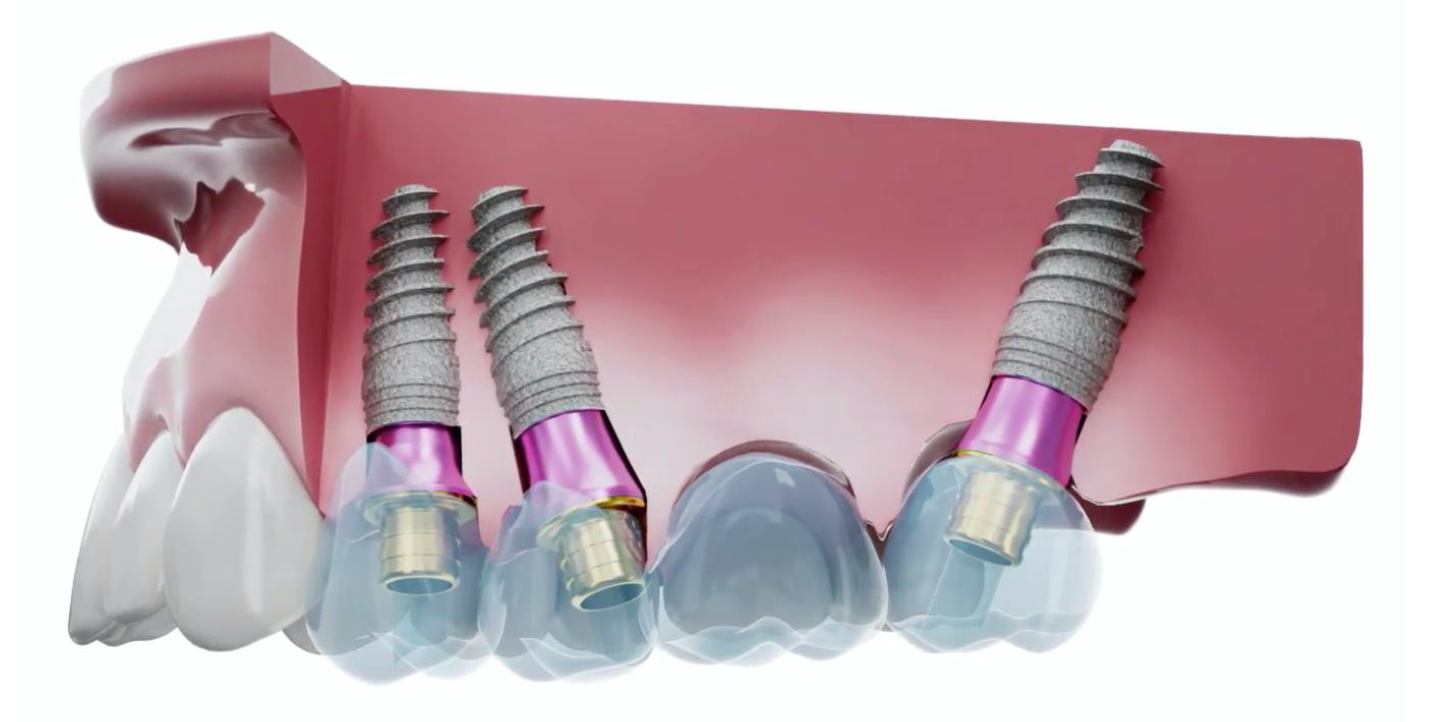 3D illustration of a mandible with dental implants and V-Type Multi-Unit Abutments demonstrating angulation correction.