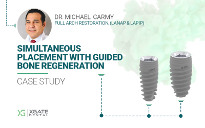 Simultaneous Placement of XGate Dental Implants with Guided Bone Regeneration