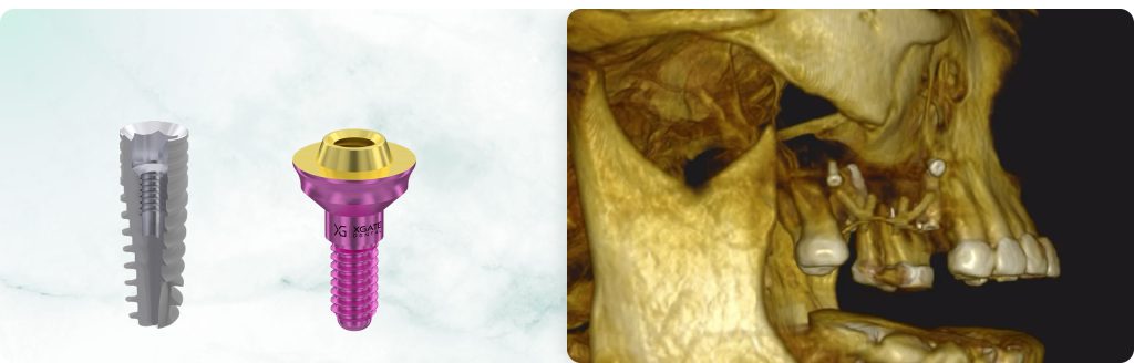 Simultaneous Placement of XGate Dental Implants with Guided Bone Regeneration