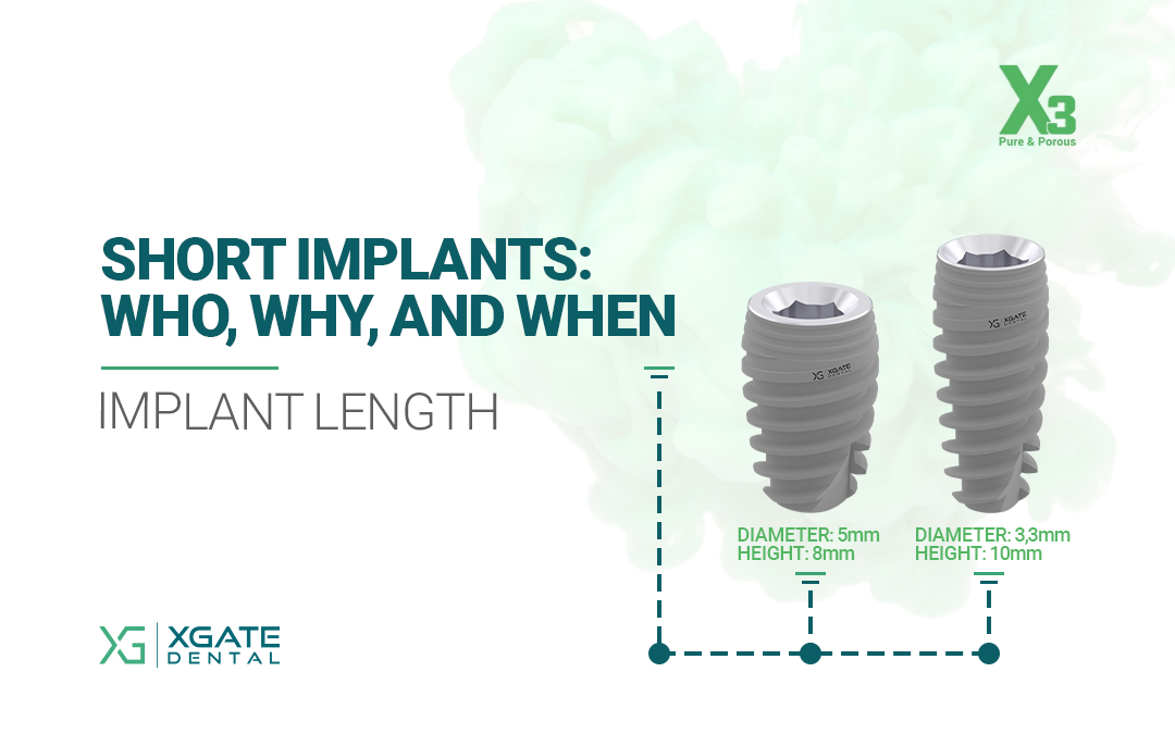 Short Implants: Who, Why, and When (Implant Length). XGate
