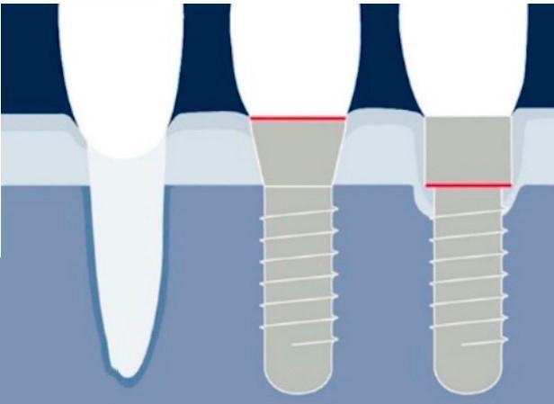 Dental Implant Types Bone Remodeling Cross-Section Diagram Comparison diagram showing natural tooth, bone level dental implant, and tissue level dental implant in jawbone