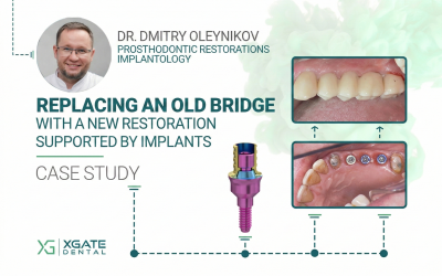 Replacing an old bridge with a new restoration supported by implants and XGATE Dental V-Type abutments