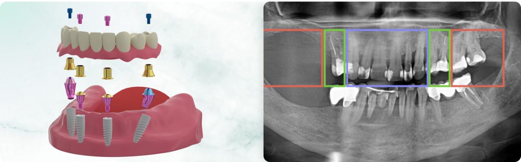 Immediate Full-Arch Restoration on 4/6 Implants. Part 2