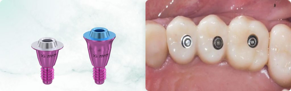 Replacing an old bridge with a new restoration supported by implants and XGATE Dental V-Type abutments