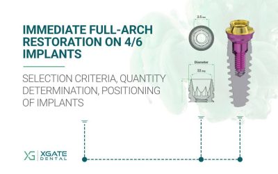 Immediate Full-Arch Restoration on 4/6 Implants