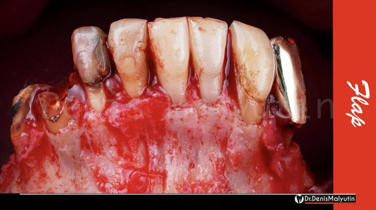 Lingual view of mandibular anterior teeth showing exposed gingival tissue and tooth surfaces