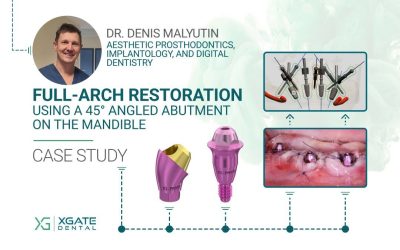 Using a 45° Angled Abutment on the Mandible for a Full-Arch Restoration