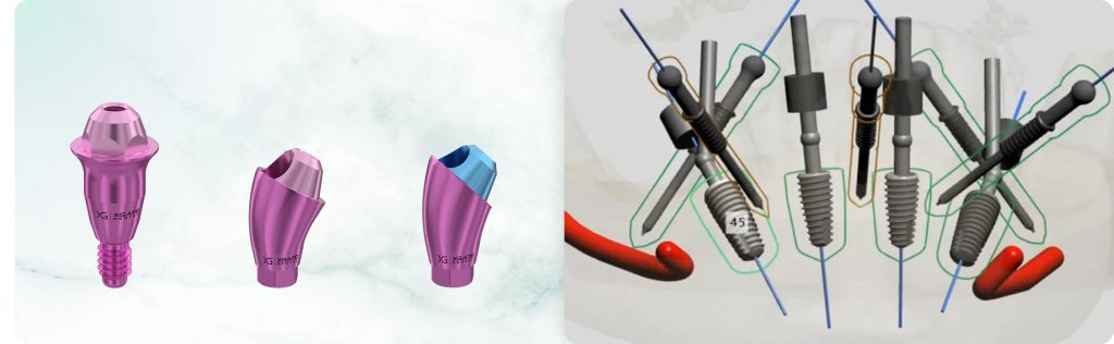 Using a 45° Angled Abutment on the Mandible for a Full-Arch Restoration