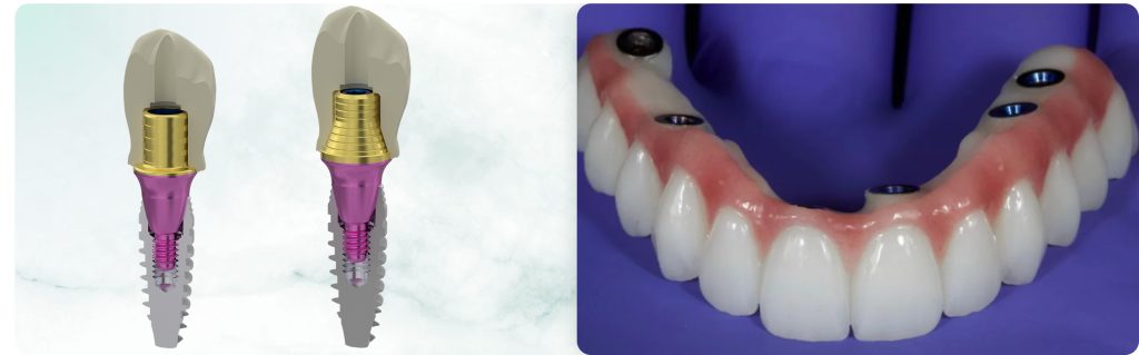 Prospects for the Use of Zirconia, Ceramics, and Composite Materials for Prosthetic Fabrication. Long-Term Prognosis and Clinical Choice.