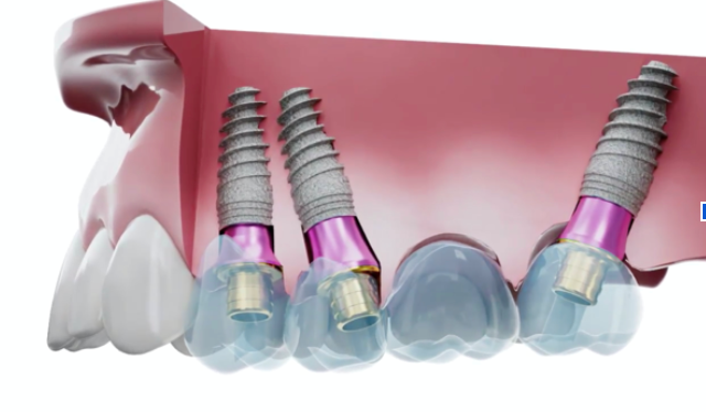 Angulation compensation with multi-unit abutments 3D render of tilted implants with angled multi-unit abutments supporting a fixed bridge.