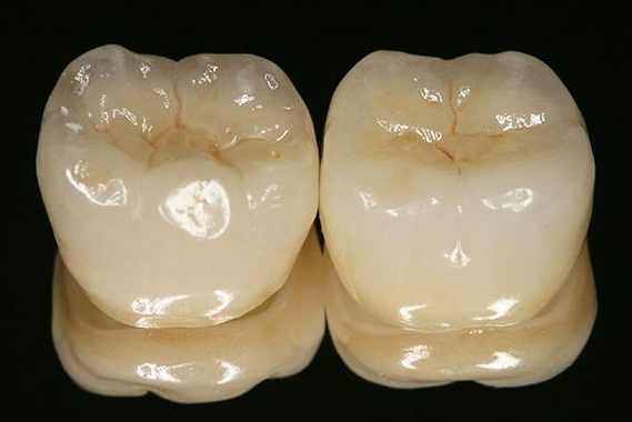 Lithium disilicate (e.max) molar crowns Two glossy lithium disilicate posterior crowns showing enamel-like translucency on a black background.