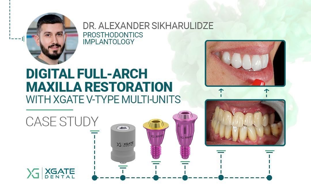 Full-Arch Restoration of the Maxilla Full-Arch Restoration of the Maxilla