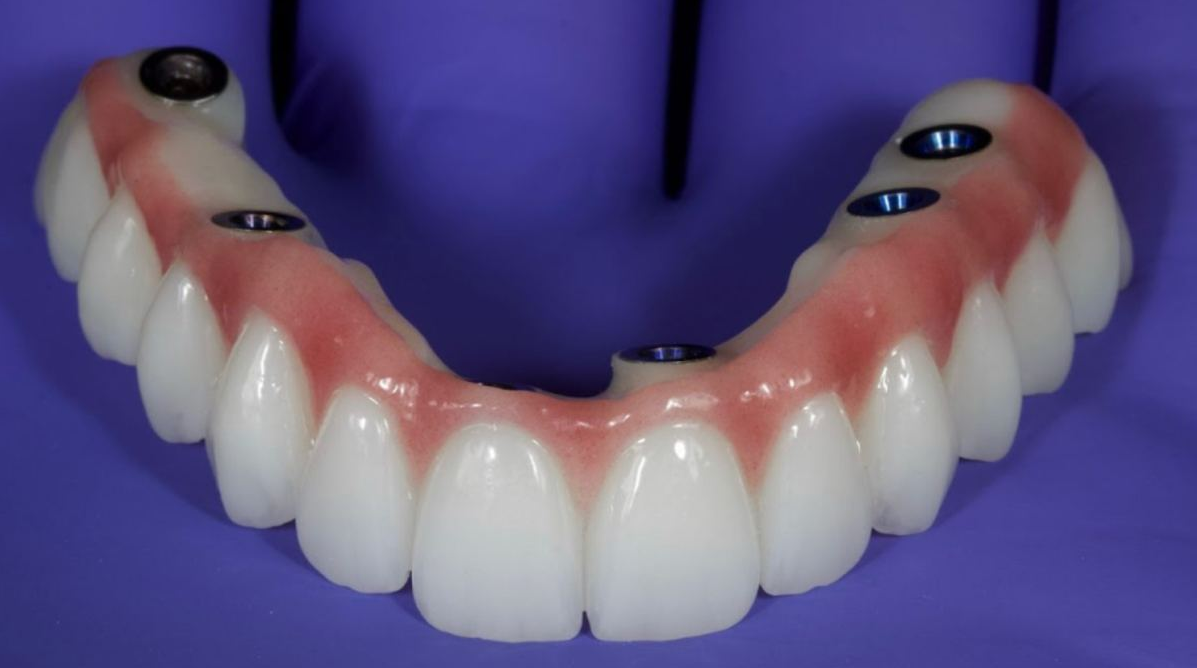 Full-arch screw-retained zirconia prosthesis Intaglio view of a monolithic zirconia full-arch bridge with multiple screw access channels.